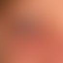 Endocrine orbitopathy: known immunogenic hyperthyroidism (Graves' disease) with distinct exophtha...