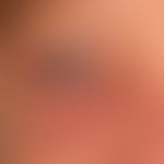 Lidschwellung bei endokriner Orbitopathie:&nbsp;bekannte immunogene Hyperthyreose (M. Basedow) mi...