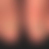 Onycholysis in epidermolysis bullosa acquisita
