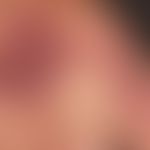 Malformationen vaskuläre: Nicht-syndromale kapilläre Malformation (Naevus flammeus/Port-wine stain)
