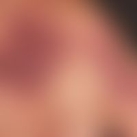 Malformationen vaskuläre: Nicht-syndromale kapilläre Malformation (Naevus flammeus/Port-wine stain)
