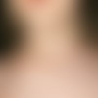 Malformation vaskuläre (subkutanes Lymphangioma cavernosum):&nbsp;erstmals im 1. LJ bemerkte, mit...