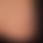 Neurofibromatose segmentale: umschriebene weiche Papeln und Knoten.&nbsp;
