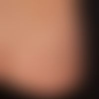 Neurofibromatose segmentale: umschriebene weiche Papeln und Knoten.&nbsp;
