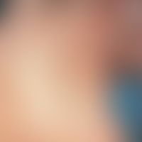 Neurofibromatosis, segmental. segmentally arranged skin-coloured, soft, broad-based tumours in th...