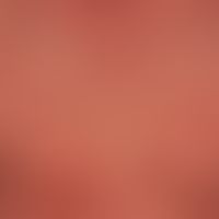 Pityriasis rubra pilaris (adulter Typ):&nbsp;seit Jahren chronisch-rezidivierender Verlauf mit Ph...