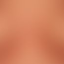 Psoriasis intertriginosa: infektinduzierte, akute (intertriginös akzentuierte) Schubaktivität ein...