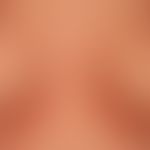 Psoriasis intertriginosa: infection-induced, acute (intertriginously accentuated) relapsing activ...