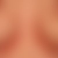 Psoriasis intertriginosa: infection-induced, acute (intertriginously accentuated) relapsing activ...