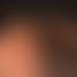 Psoriais capitis: Largely untreated psoriasis of the capillitium, extensive coating of scaly crus...