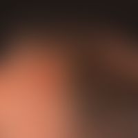 Psoriais capitis: Largely untreated psoriasis of the capillitium, extensive coating of scaly crus...