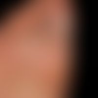Psoriasis: chronische Psoriasis plantaris mit flächenhaftem &nbsp;Befall des&nbsp;Vorfußes und de...