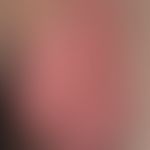 Psoriasis intertriginosa: extensive psoriatic affection of the scrotum combined with distinct itc...