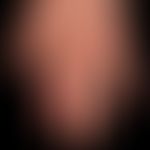 Psoriasis arthropathica: Acralaccentuated psoriasis vulgaris (features of acrodermatitis continua...