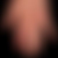 Psoriasis arthropathica: Acralaccentuated psoriasis vulgaris (features of acrodermatitis continua...