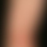 Lichen planus classic type: for several months, red, itchy, polygonal, partially confluent, smoot...