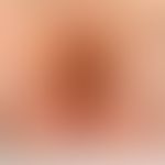 Exanthematic lichen planus withinfestation of the integument and oral mucosa, here: infestation o...