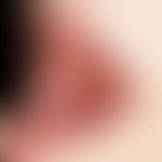 Lichen planus mucosae: whitish-grey, laminar, net-like change in the cheek mucosa.
