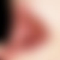 Lichen planus mucosae: whitish-grey, laminar, net-like change in the cheek mucosa.
