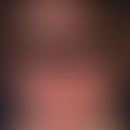 Skleromyxödem.&nbsp;Bei der 46jährigen Patientin zeigt sich eine diffus verdickte und diskret ger...