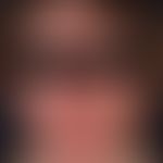 Skleromyxödem.&nbsp;Bei der 46jährigen Patientin zeigt sich eine diffus verdickte und diskret ger...