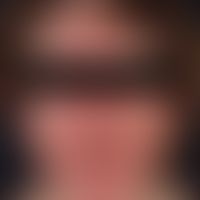 Skleromyxödem.&nbsp;Bei der 46jährigen Patientin zeigt sich eine diffus verdickte und diskret ger...