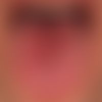 Plaques muqueuses: disseminated, localised red, symptom-free plaques confluent in the centre of t...