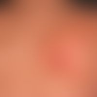 Radiodermatitis chronica: Zustand nach Bestrahlung eines Bronchialkarzinoms.
