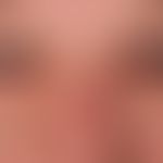 Lidschwellung: chronisches, idiopathisches&nbsp;Lidödem &nbsp;mit monströsen "Tränensäcken".
