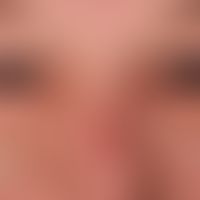 Lidschwellung: chronisches, idiopathisches&nbsp;Lidödem &nbsp;mit monströsen "Tränensäcken".
