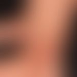 Livedovaskulopathie: hämorrhagisch-nekrotische Lasionen auf erythematösem Grund. Periulzeröses Li...