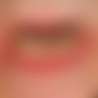 Lichen planus mucosae: discrete infestation of the lower lip, no subjective symptoms.
