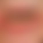 Lichen planus mucosae: white encircles the lichen planus of the lower lip with rather discrete wh...