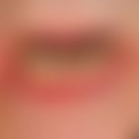 Lichen planus mucosae: white encircles the lichen planus of the lower lip with rather discrete wh...