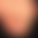 Clavus: druckbedingte Schwielenreaktion über den Mttelgelenken der 2. und 3. Zehe. Ausgeprägter H...