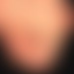 Clavus: druckbedingte Schwielenreaktion über den Mttelgelenken der 2. und 3. Zehe. Ausgeprägter H...