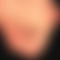 Clavus: pressure-related callus reaction above the mttel joints of the 2nd and 3rd toe; pronounce...