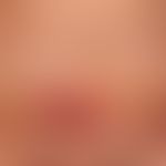 Hämatom: vorbekannter chronischer Lichen sclerosus (Stellen eingekreist). Nicht ganz frische Einb...