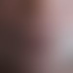 Leishmaniasis (mucocutaneous leishmaniasis of the old world): Ethiopian (HIV-infected) patient wi...