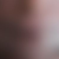 Leishmaniasis (mucocutaneous leishmaniasis of the old world): Ethiopian (HIV-infected) patient wi...