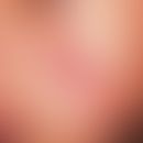 Leishmaniose, kutane:&nbsp;mit gelblich-weißlicher Kruste belegte, oberflächlich ulzerierte, raue...