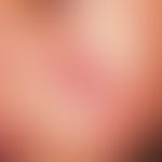 Leishmaniose, kutane:&nbsp;mit gelblich-weißlicher Kruste belegte, oberflächlich ulzerierte, raue...