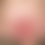 Leishmaniose, kutane:&nbsp;mehrere Wochen nach einem Mallorca-Urlaub aufgetretene, rundliche, röt...