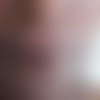 Mucocutaneous leishmaniasis: in an HIV-infected patient; severe, nonpainful swelling of the upper...