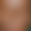 Alopecia&nbsp;lepromatosa: kompletter Verlust der Augenbrauen, partieller Verlust der Wimpern bie...