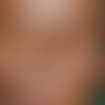 Alopecia lepromatosa: complete loss of eyebrows, partial loss of eyelashes in leprosy lepromatosa.
