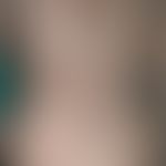 Lepra&nbsp;(dimorphe Lepra):&nbsp;hier als tuberkuloider Borderline-Typ mit großflächiger&nbsp;ka...