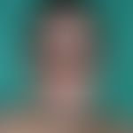 Leprosy lepromatosa: Boderline type of leprosy lepromatosa; inflammatory type I reaction (leprosy...