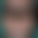 Lepra lepromatosa:&nbsp;fortgeschrittener Befund mit &nbsp;zahlreichen , nahezu symmetrisch verte...
