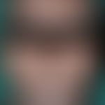 Leprosy lepromatosa: advanced findings with numerous, almost symmetrically distributed, asymptoma...